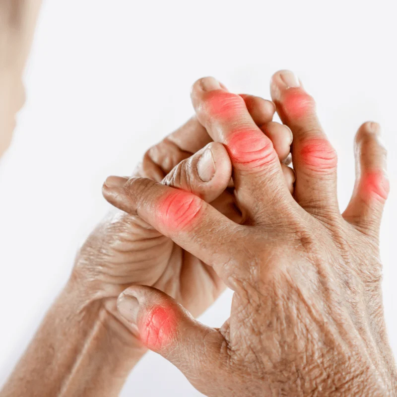 Arthritis Pain Treatment Sangamner